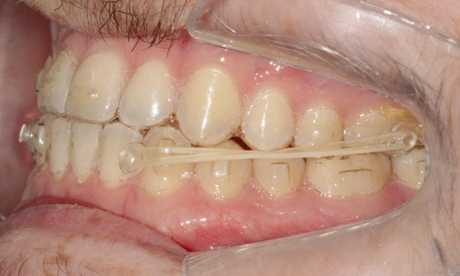 Residência em Alinhadores Angel Aligner - Turma 2