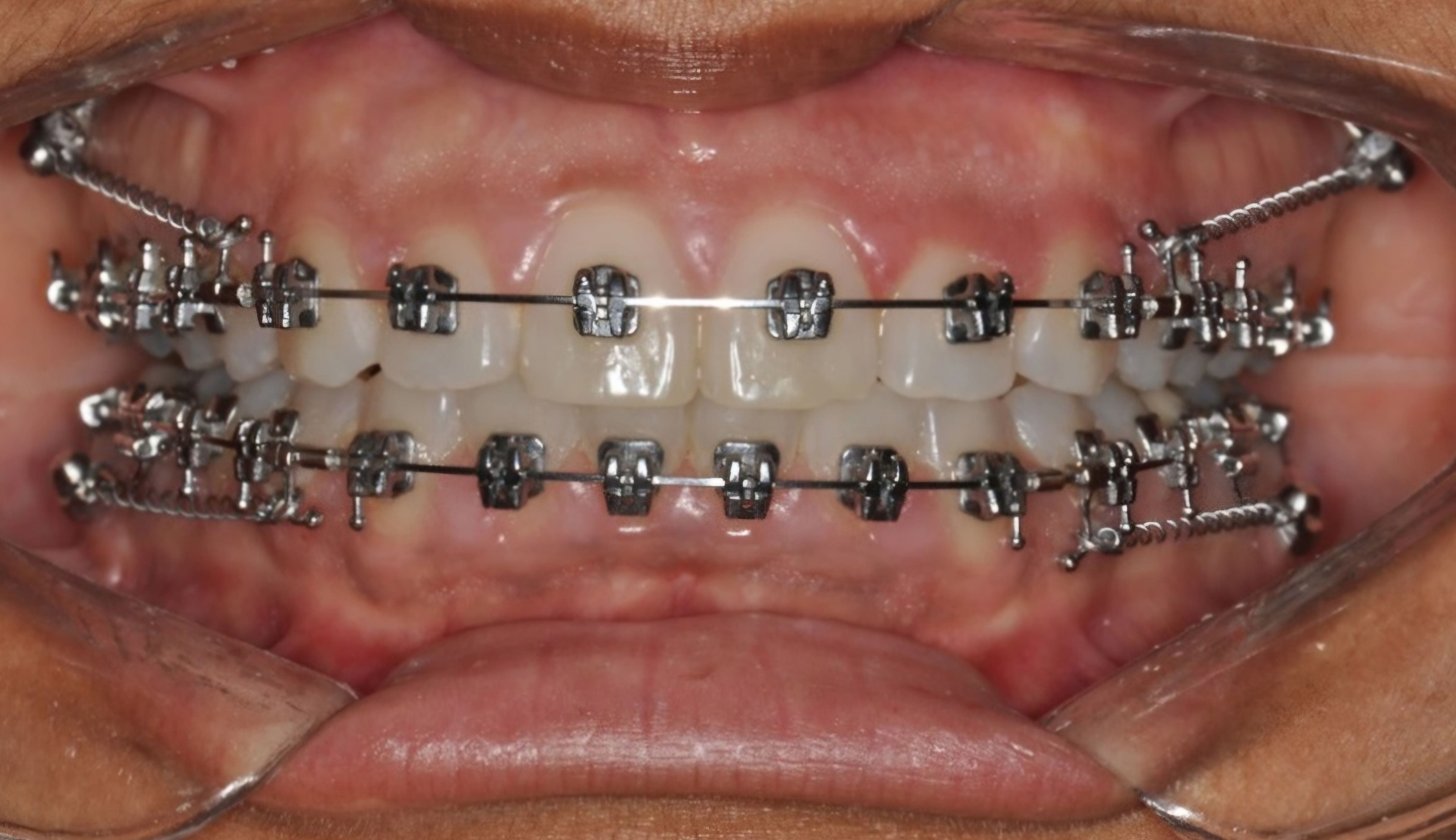 Ancoragem Esquelética