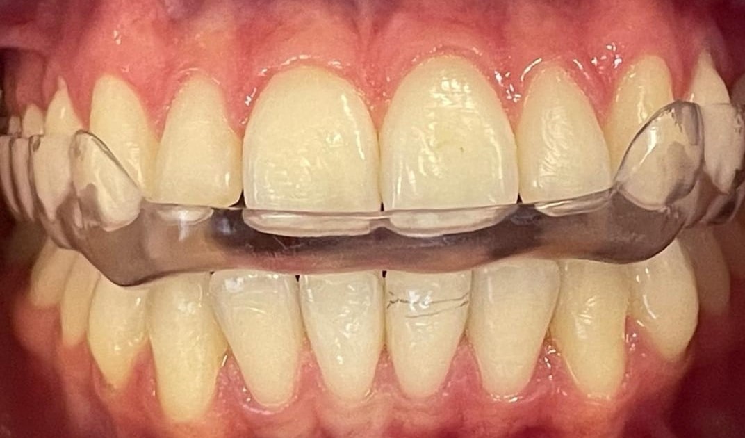 Bruxismo: um curso completo da teoria à prática clínica